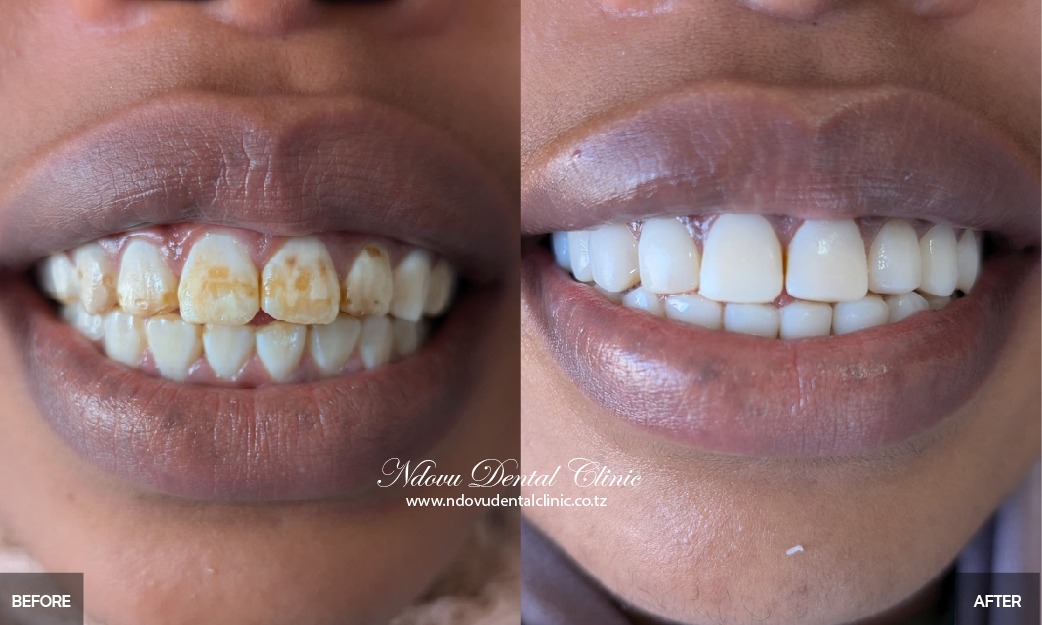 before & After-01