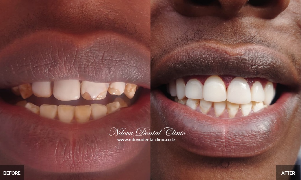 before & After-02