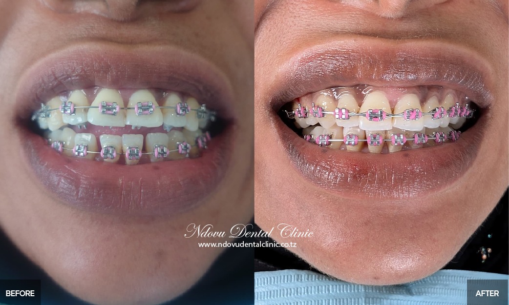before & After-03