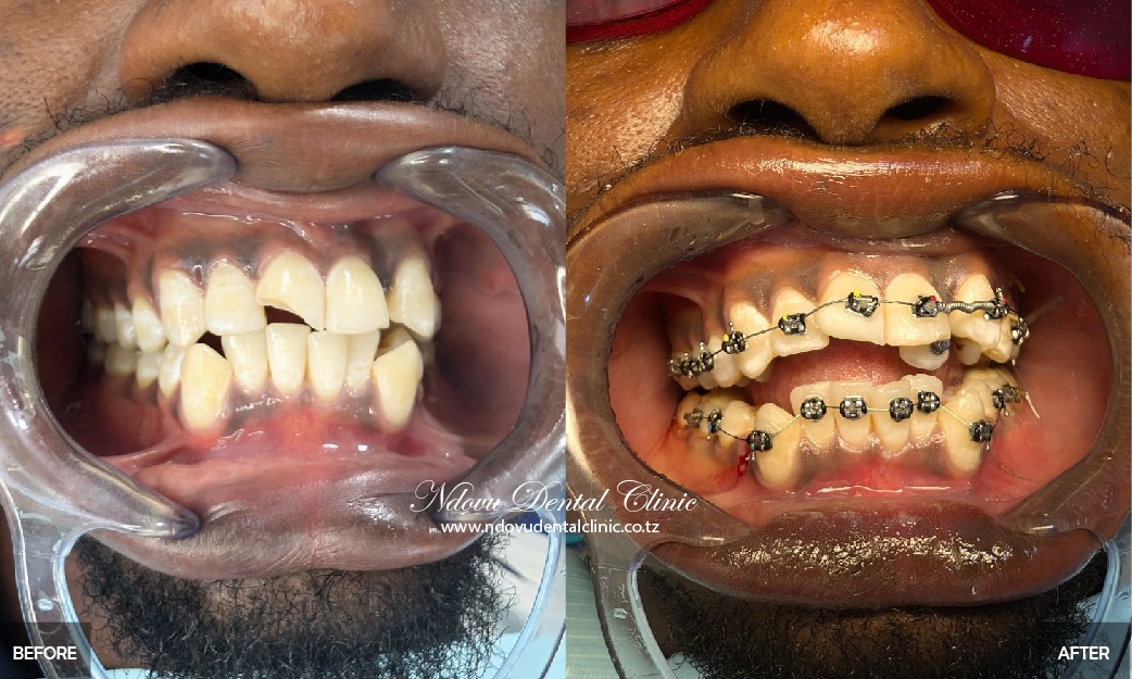 before & After-04