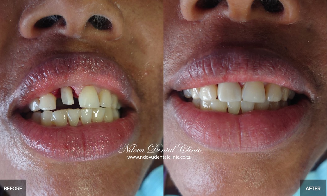 before & After-05