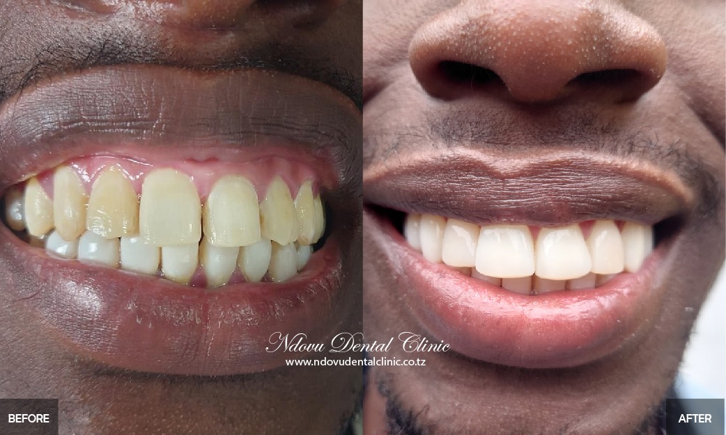 before & After-10