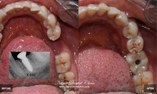 before & After-=-09